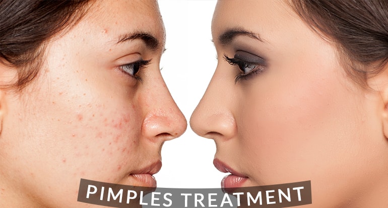 Acne And Pimple Treatment